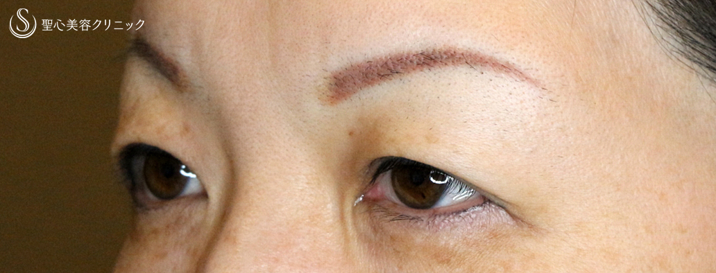 【50代女性・整形ではなく若返り治療】眉下リフト+α単独（8年後） Before 