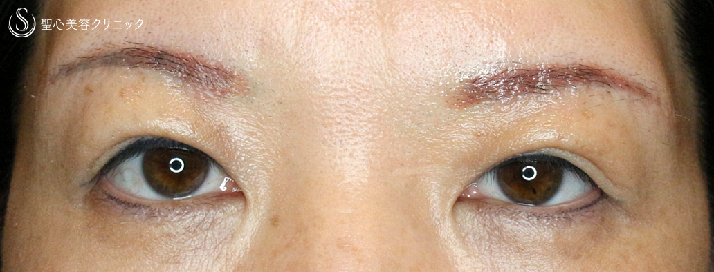 【50代女性・整形ではなく若返り治療】眉下リフト+α単独（8年後） After 