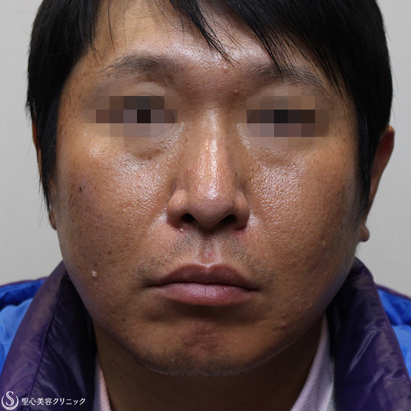 40代男性 鼻を男らしく 隆鼻術 プロテーゼ 1ヶ月後 症例写真 美容整形 美容外科なら聖心美容クリニック