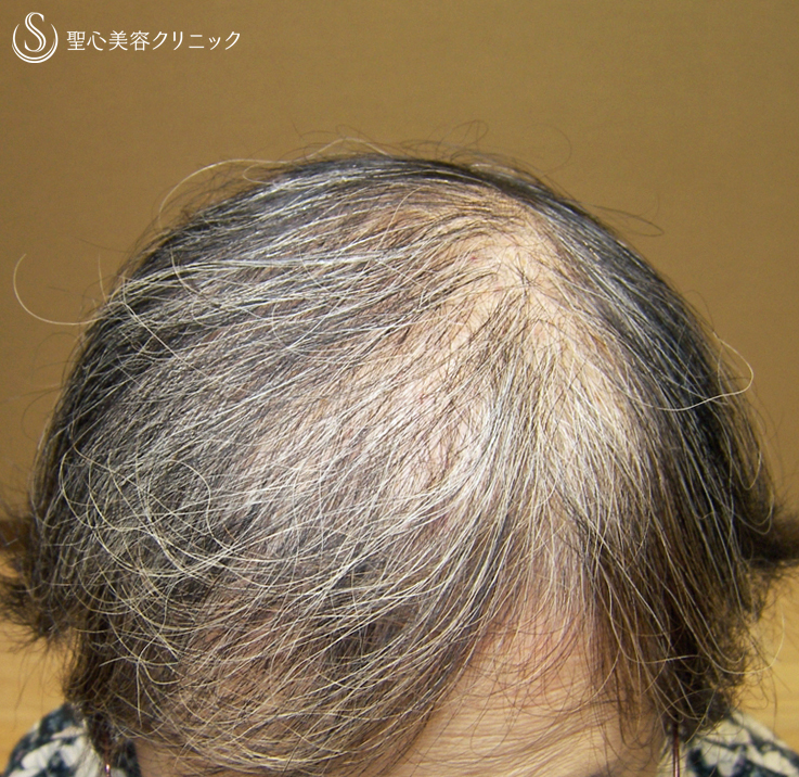 【60代女性・白髪や髪質まで改善】グロースファクター毛髪再生療法（6回後） Before 