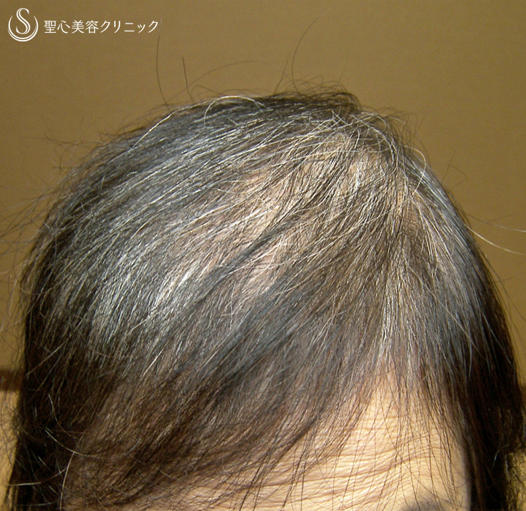 【60代女性・白髪や髪質まで改善】グロースファクター毛髪再生療法（6回後） After 
