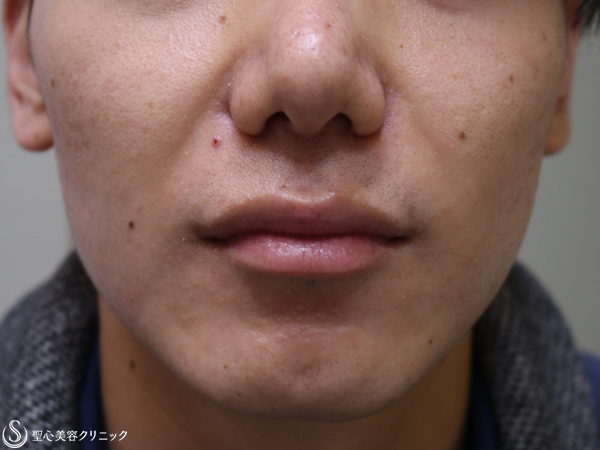 【20代男性・鼻先と小鼻をすっきり】鼻尖縮小（外側法）＋小鼻縮小（1ヶ月後） After 
