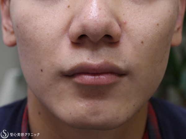 【20代男性・鼻先と小鼻をすっきり】鼻尖縮小（外側法）＋小鼻縮小（1ヶ月後） Before 