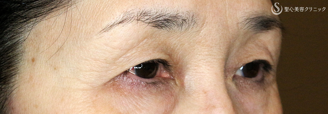 【60代女性・まぶたのタルミ＆三角目】眉下リフト（術後1ヶ月） Before 