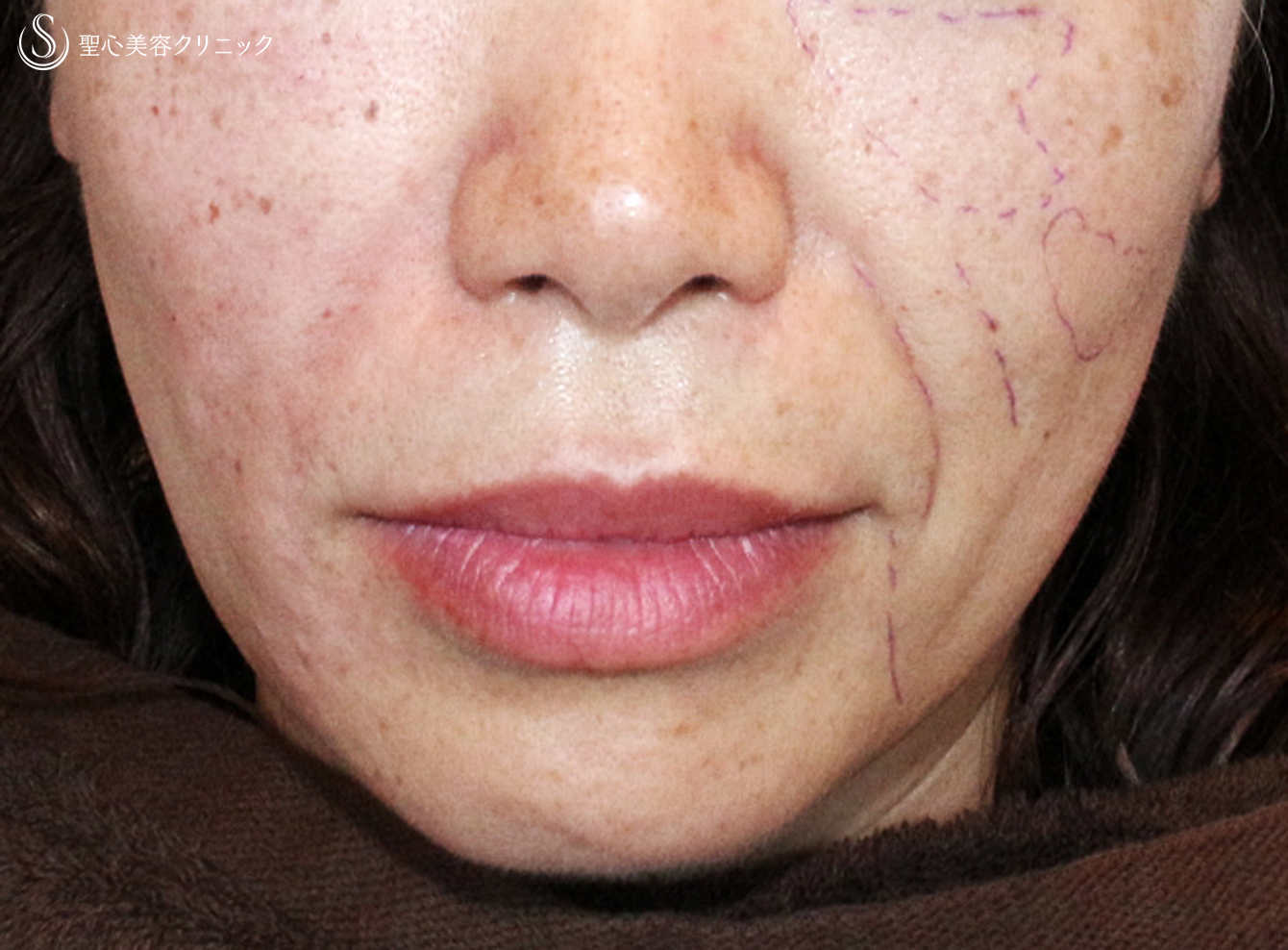 【40代女性・法令線+リフトアップ】プレミアムPRP皮膚再生療法（5ヶ月後） After 
