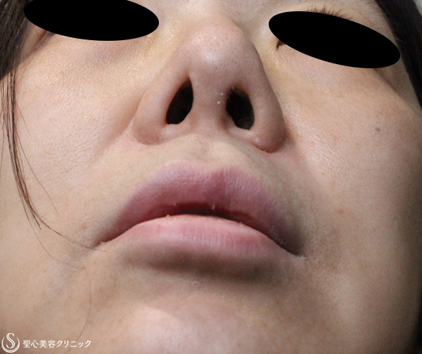 【50代女性・鼻孔の左右差を修正】鼻孔縁複合組織移植術（2週間後） Before 