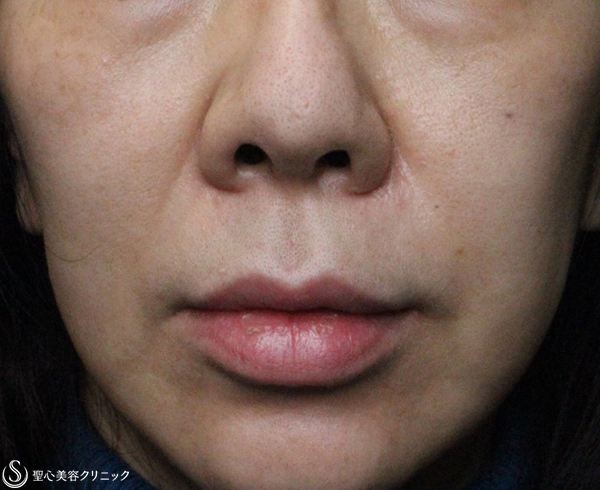 【50代女性・鼻孔の左右差を修正】鼻孔縁複合組織移植術（2週間後） After 