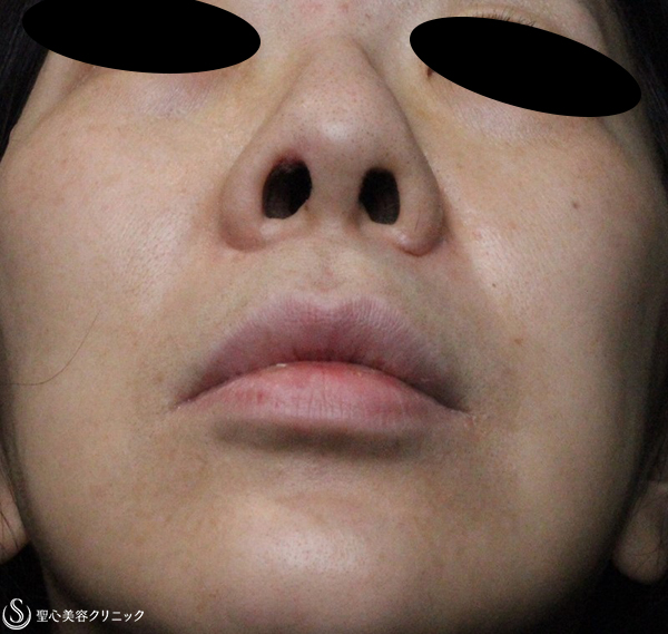 【50代女性・鼻孔の左右差を修正】鼻孔縁複合組織移植術（2週間後） After 