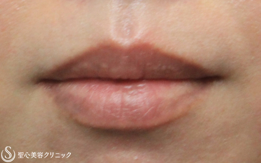 【40代女性・唇のシミをキレイに】ピコレーザー（1ヶ月後） After 