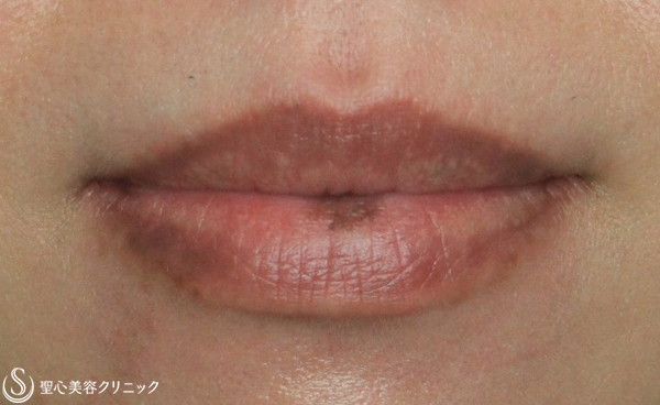 【40代女性・唇のシミをキレイに】ピコレーザー（1ヶ月後） Before 