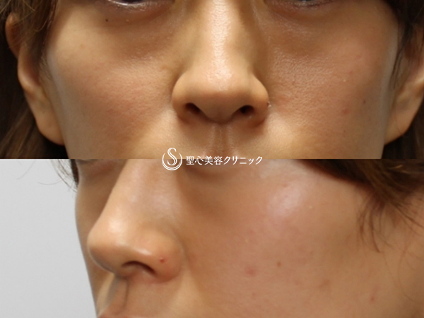 【30代女性・目の下の若返り】プレミアムPRP皮膚再生療法（3ヶ月後） Before 