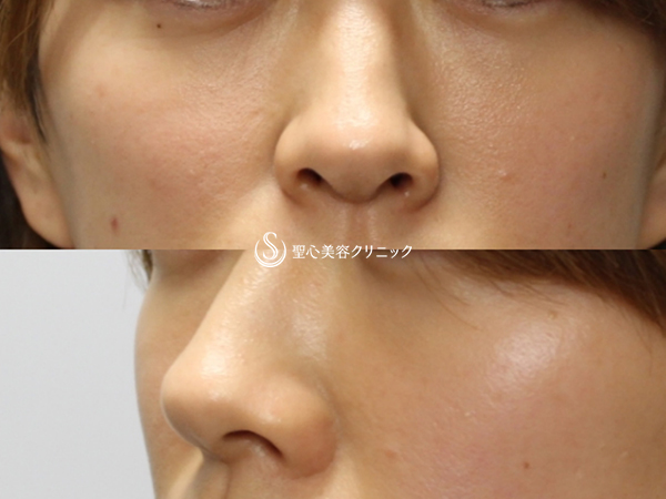 【30代女性・目の下の若返り】プレミアムPRP皮膚再生療法（3ヶ月後） After 