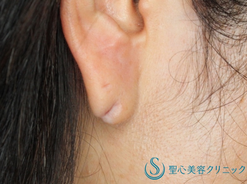 30代女性 ピアスによる耳垂裂 ピアス穴閉じ修正 術後2年半 症例写真 美容整形 美容外科なら聖心美容クリニック 30代女性 ピアスによる耳垂裂 ピアス穴閉じ修正 術後2年半 症例写真 美容整形 美容外科なら聖心美容クリニック