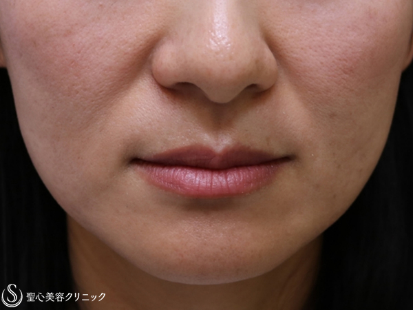 【40代女性・ほうれい線の改善】プレミアムPRP皮膚再生療法（3ヶ月後） Before 