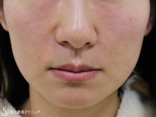 【40代女性・ほうれい線の改善】プレミアムPRP皮膚再生療法（3ヶ月後） After 