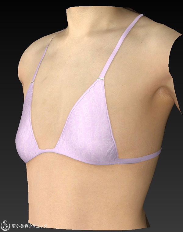 【女性・Aカップから大き目バストへ】バッグプロテーゼ挿入法（モディバ310cc） Before 