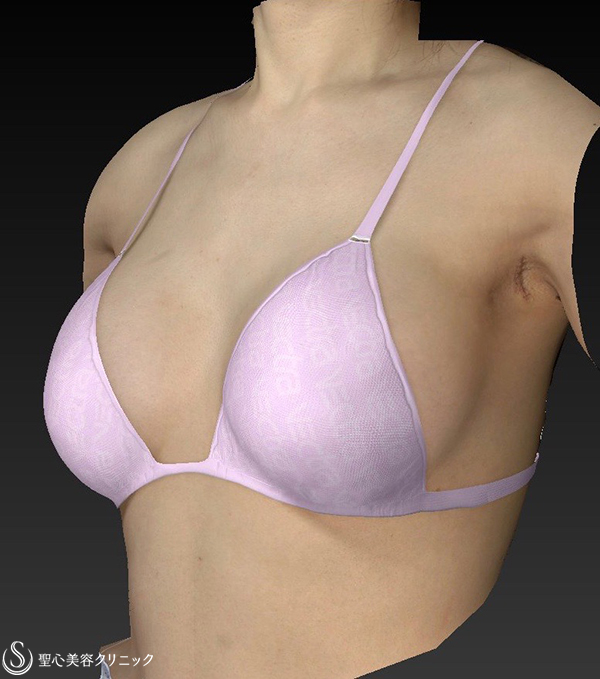 【女性・Aカップから大き目バストへ】バッグプロテーゼ挿入法（モディバ310cc） After 