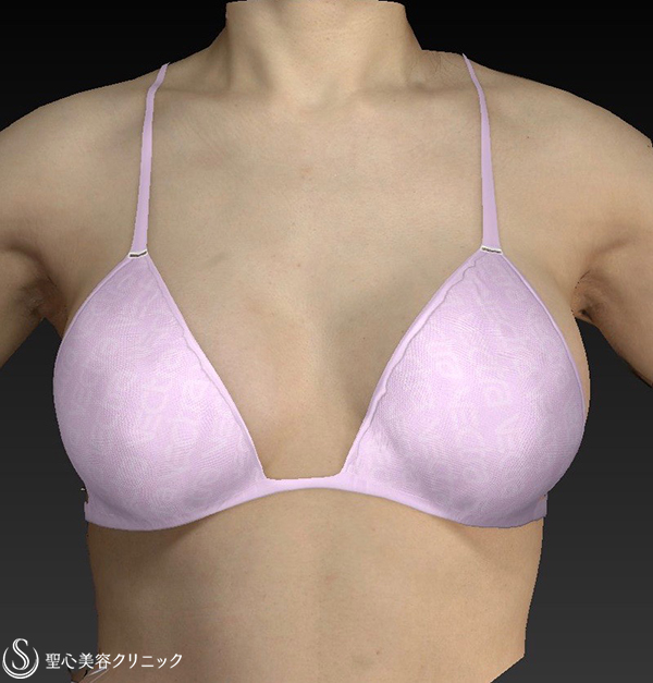 【女性・Aカップから大き目バストへ】バッグプロテーゼ挿入法（モディバ310cc） After 