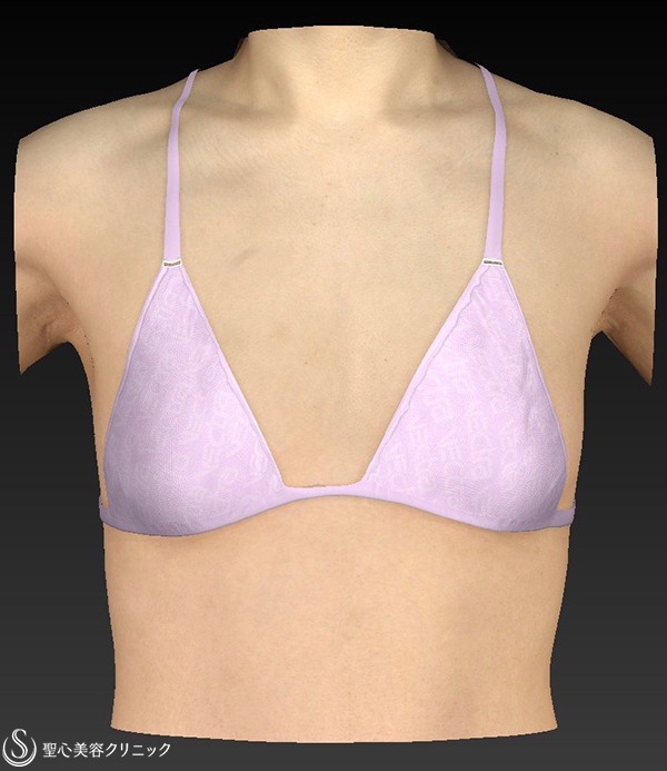 【女性・Aカップから大き目バストへ】バッグプロテーゼ挿入法（モディバ310cc） Before 