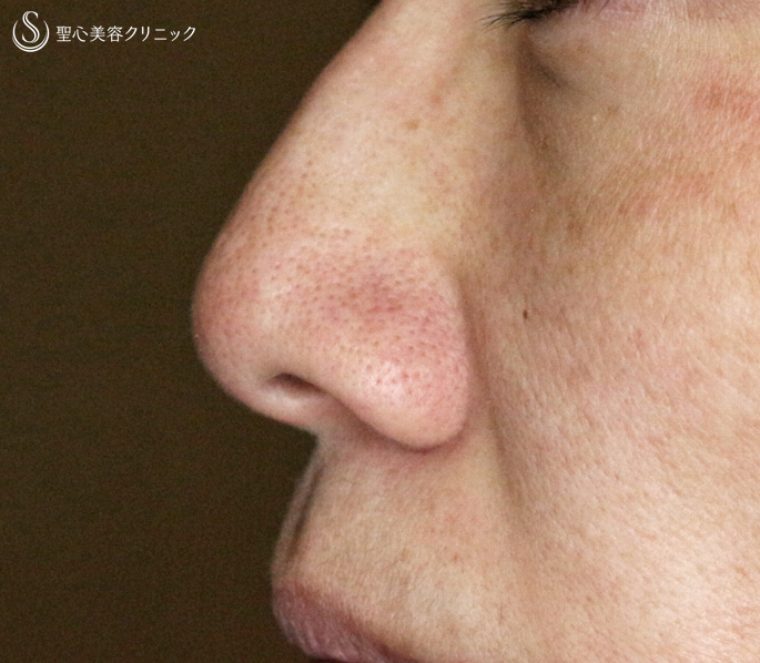 【40代女性・特徴的な小鼻】小鼻縮小術+α法（3年後） Before 