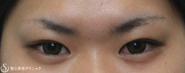 【10代女性・戻りにくい二重に】二重術（切開法）（4年後） After 