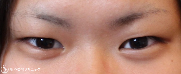 【10代女性・戻りにくい二重に】二重術（切開法）（4年後） Before 
