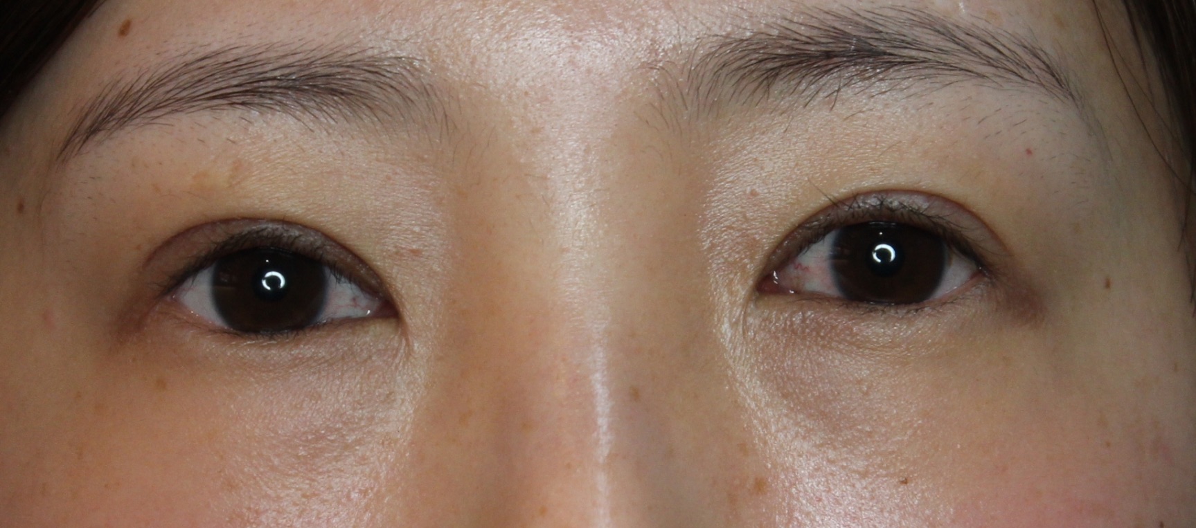 【20代女性・他院修正】二重全切開後修正 After 