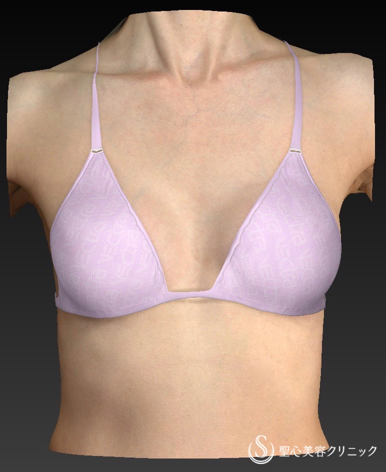 【女性・バストアップ】バッグプロテーゼ挿入法(モティバ185cc) After 
