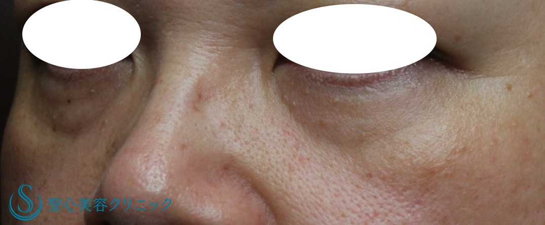 【50代女性・目の下の若返り】プレミアムPRP皮膚再生療法（処置後8ヶ月） Before 