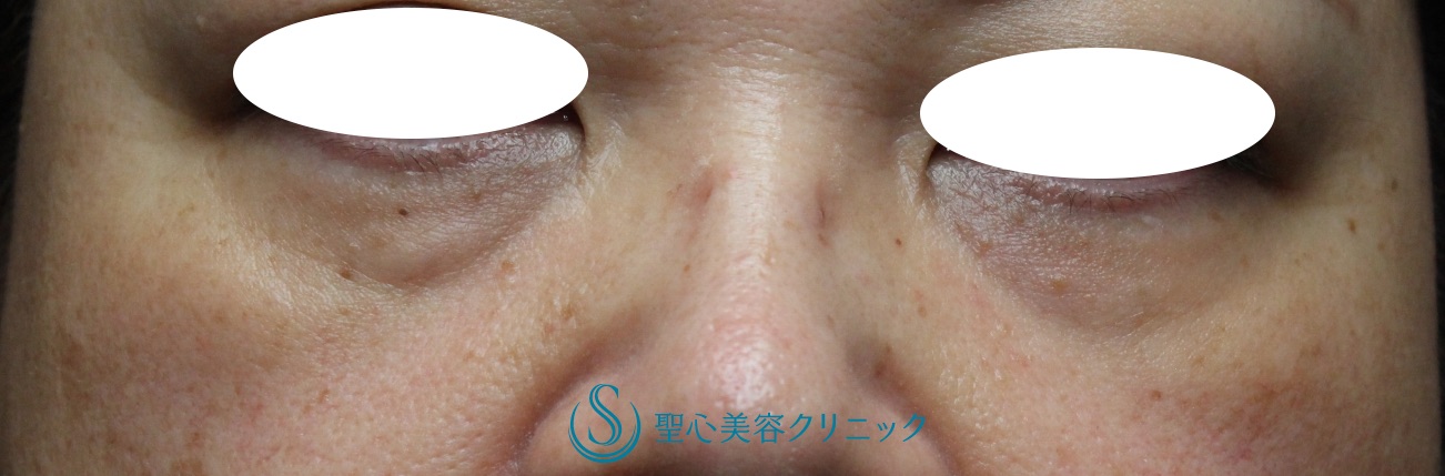 【50代女性・目の下の若返り】プレミアムPRP皮膚再生療法（処置後8ヶ月） Before 