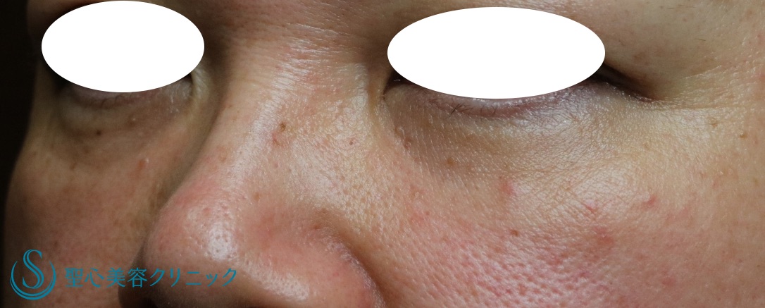 【50代女性・目の下の若返り】プレミアムPRP皮膚再生療法（処置後8ヶ月） After 
