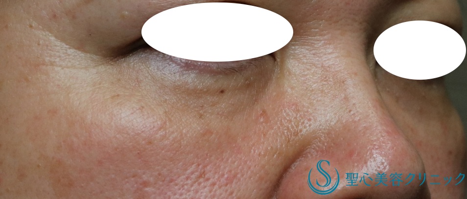 【50代女性・目の下の若返り】プレミアムPRP皮膚再生療法（処置後8ヶ月） After 