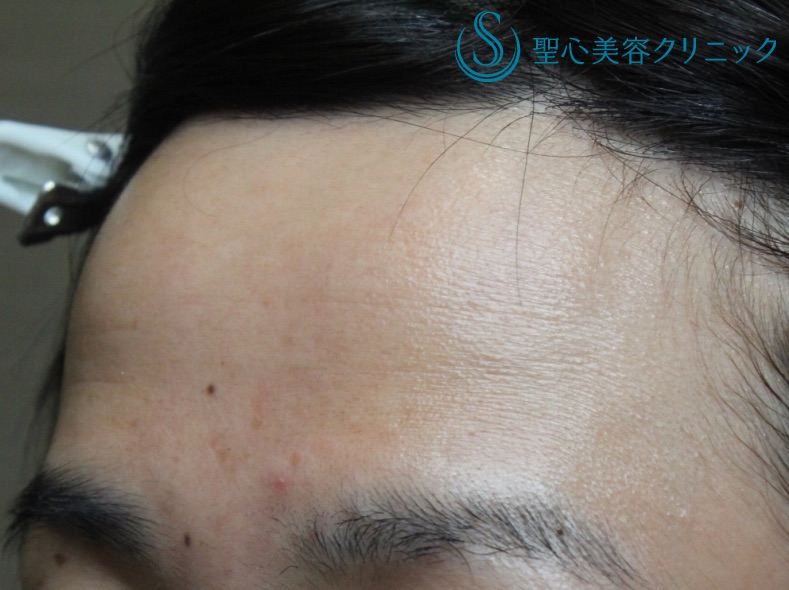 【40代女性・額を丸くする】プレミアムPRP皮膚再生療法（処置後10ヶ月） Before 