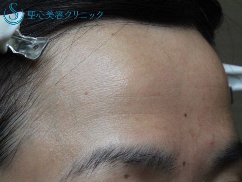 【40代女性・額を丸くする】プレミアムPRP皮膚再生療法（処置後10ヶ月） Before 