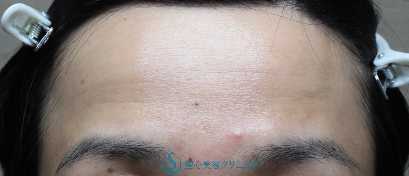 【40代女性・額を丸くする】プレミアムPRP皮膚再生療法（処置後10ヶ月） Before 