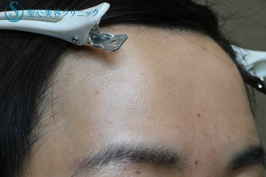 【40代女性・額を丸くする】プレミアムPRP皮膚再生療法（処置後10ヶ月） After 
