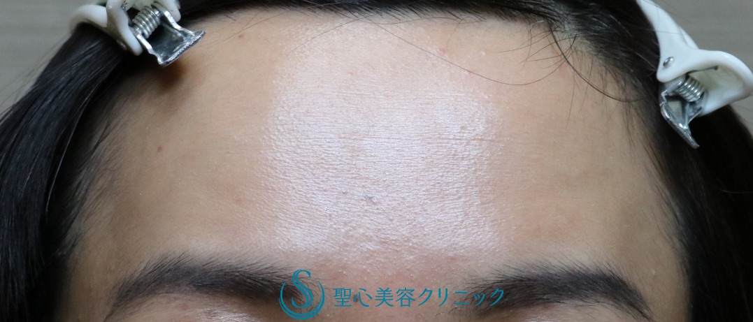 【40代女性・額を丸くする】プレミアムPRP皮膚再生療法（処置後10ヶ月） After 