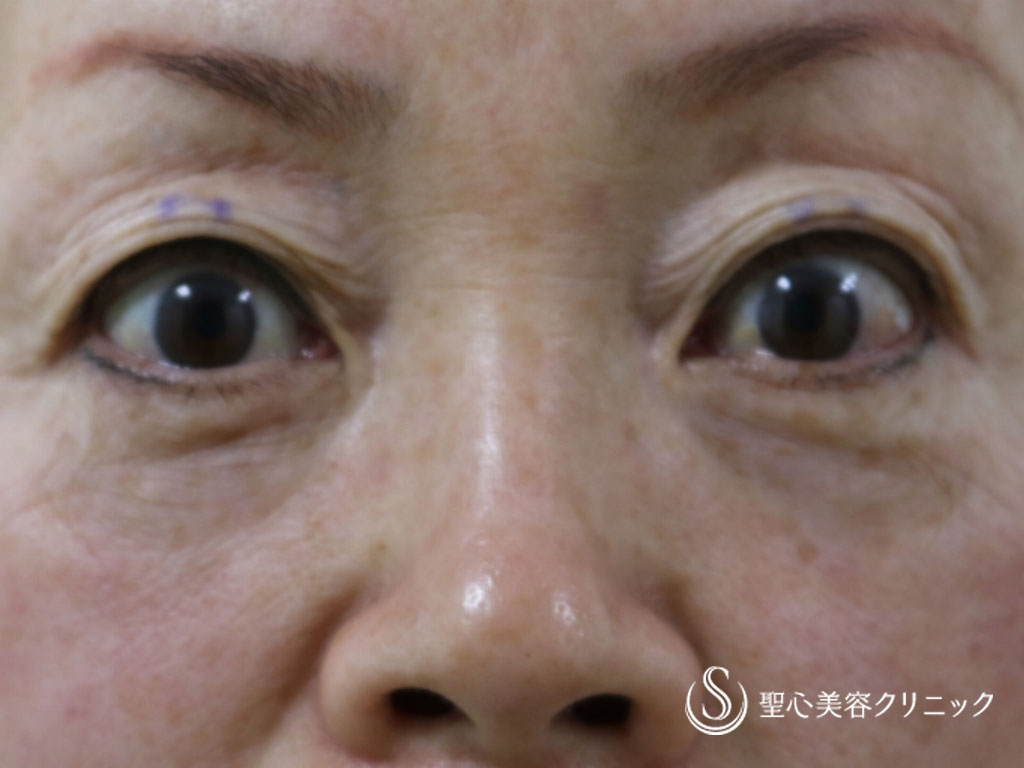 【60代女性・重いまぶたがすっきり】眼瞼下垂（埋没法）（手術直後） After 