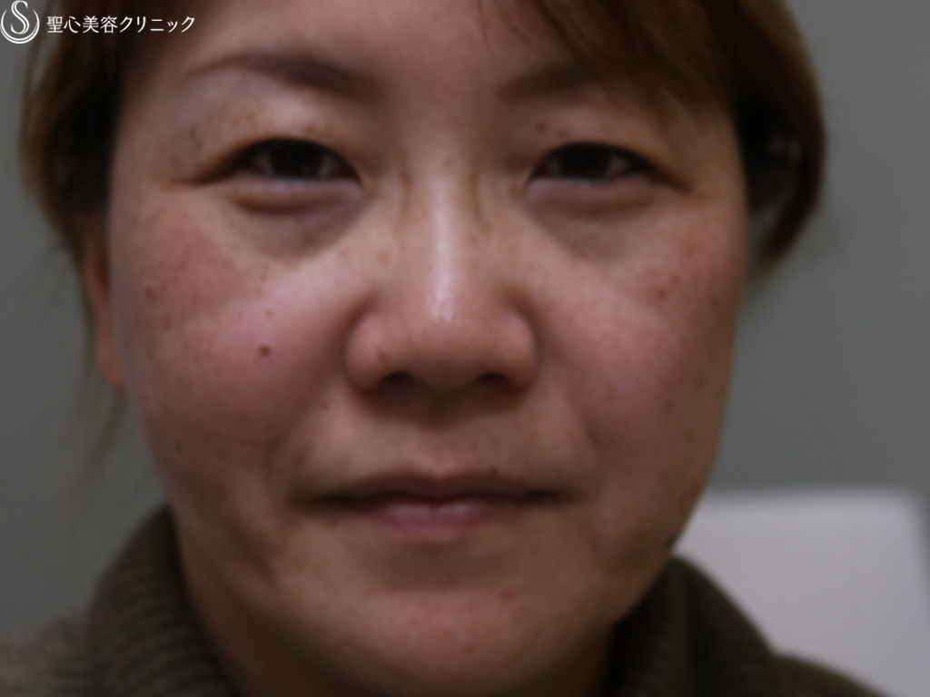 【女性・二重パッチリ、唇をふっくらと】マイクロメソッド＋α、ジュビダーム（術直後） Before 