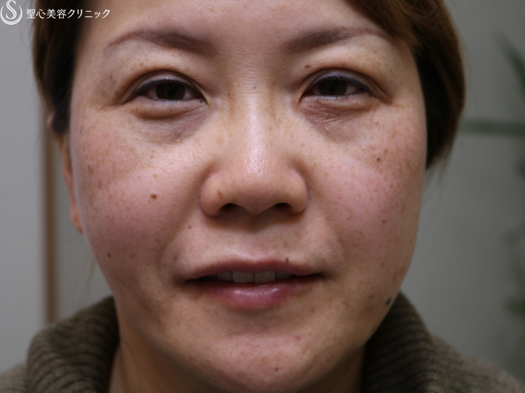 【女性・二重パッチリ、唇をふっくらと】マイクロメソッド＋α、ジュビダーム（術直後） After 