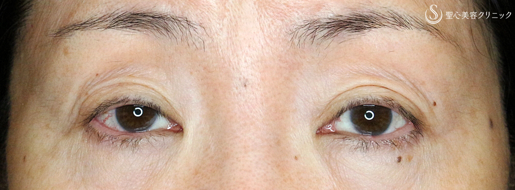 【50代女性・調節に苦労した症例】切らない眼瞼下垂+α法（1年後）札幌院 Before 