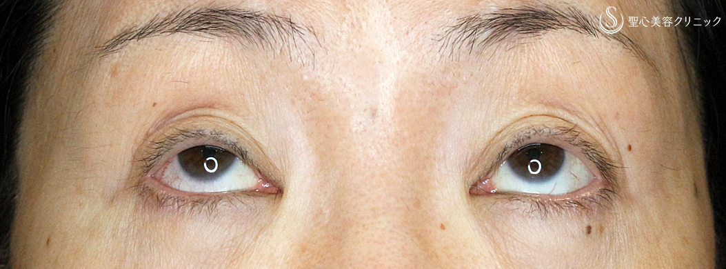 【50代女性・調節に苦労した症例】切らない眼瞼下垂+α法（1年後）札幌院 Before 