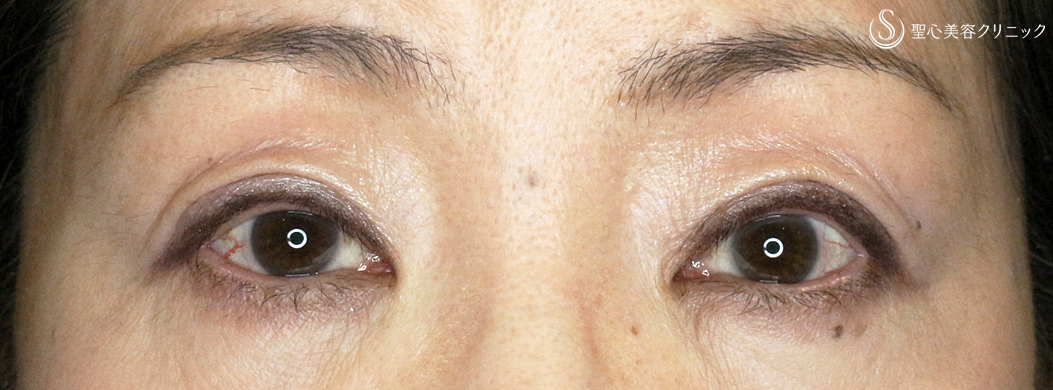 【50代女性・調節に苦労した症例】切らない眼瞼下垂+α法（1年後）札幌院 After 