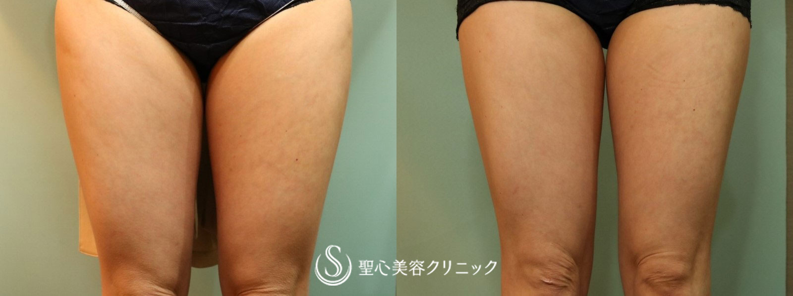 【50代女性・切らずに太ももの脂肪をスッキリと】FatX（2ヶ月後） After 