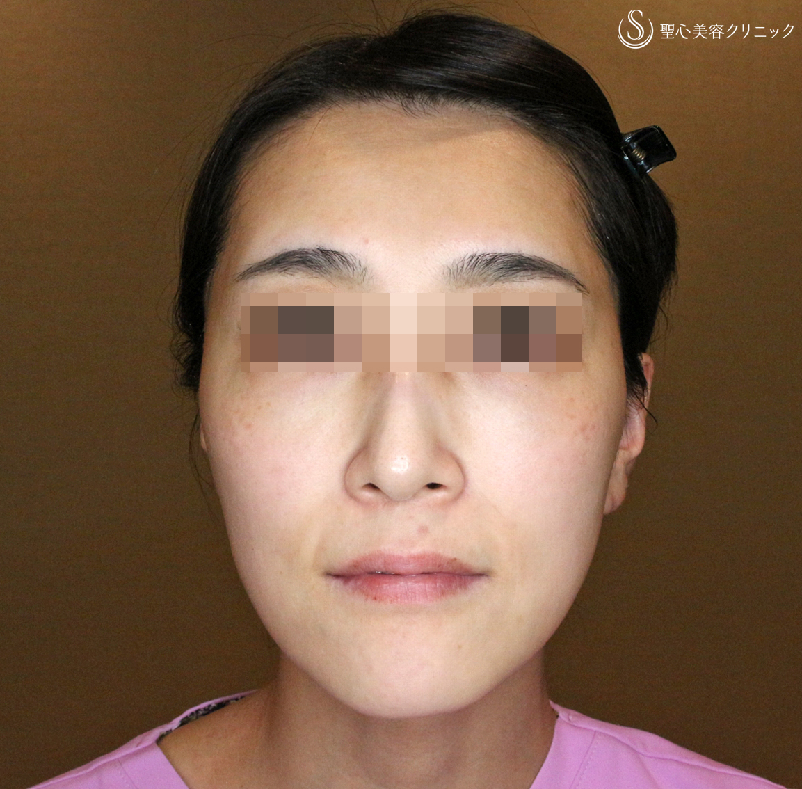 30代女性 最新のリフトアップ 小顔マシン ウルトラセルq 処置直後 札幌院 症例写真 美容整形 美容外科なら聖心美容クリニック