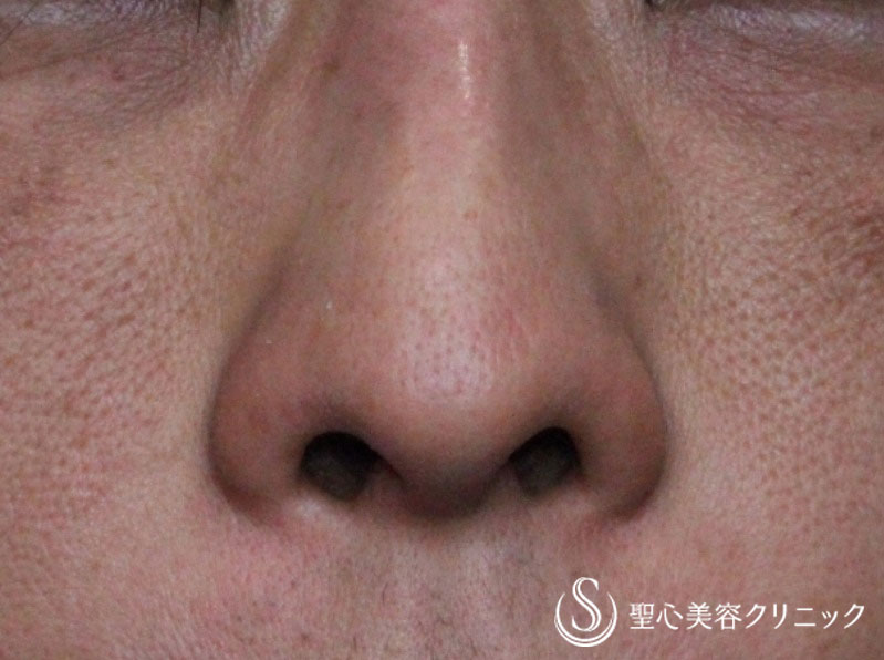 【40代男性・鼻の穴を目立たなく】小鼻縮小術（術後1ヶ月） Before 