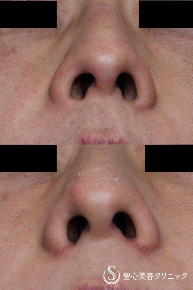 【40代男性・鼻の穴を目立たなく】小鼻縮小術（術後1ヶ月） After 