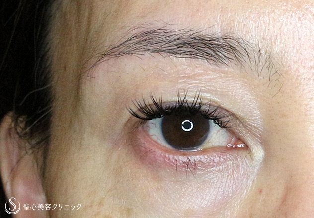 【50代女性・整形ではなく若返り治療】眉下リフト（6ヶ月後）札幌院 After 