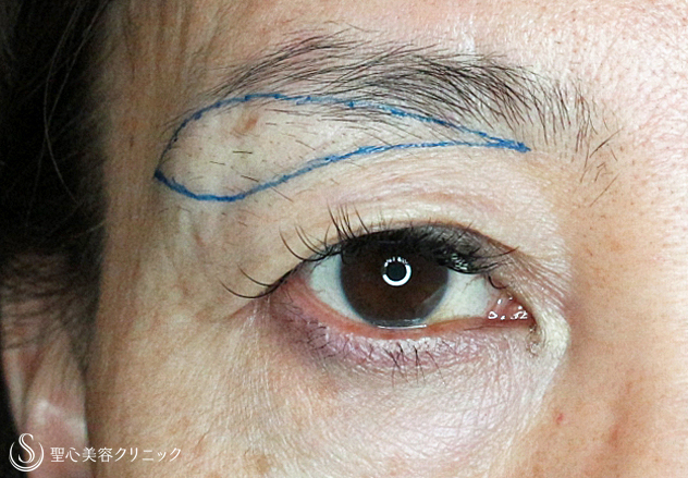 【50代女性・整形ではなく若返り治療】眉下リフト（6ヶ月後）札幌院 Before 