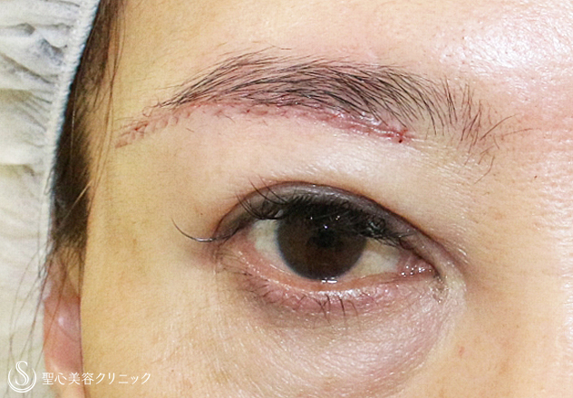 【50代女性・整形ではなく若返り治療】眉下リフト（6ヶ月後）札幌院 After 